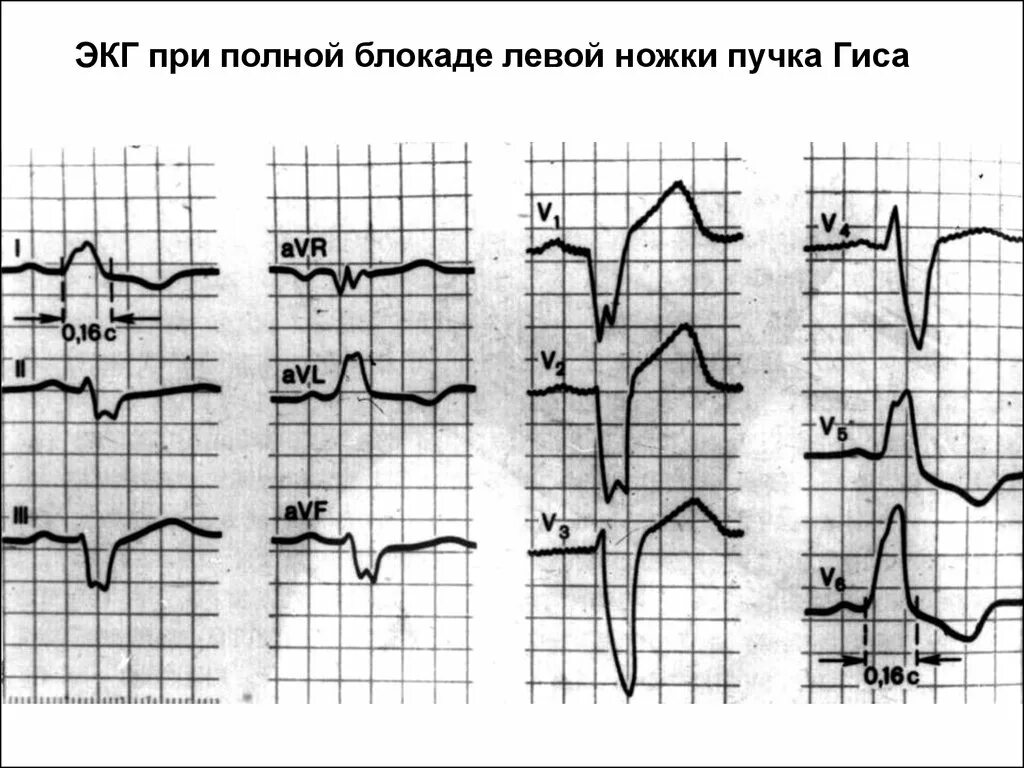 Блокада левой ножки пучка Гиса на ЭКГ. Блокада ножки пучка Гиса на ЭКГ. ЭКГ при блокаде левой ножки пучка Гиса. ЭКГ при блокадах ножки пучка Гиса.