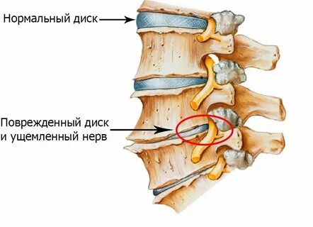 Остеофиты позвоночника что