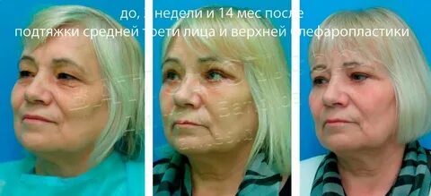 Круговая подтяжка уфе лица