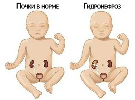 У ребенка 1 почка