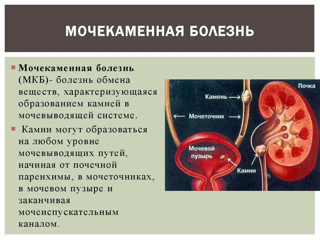 Мочекаменная болезнь причины возникновения. Заболевания мочевыделительной системы мочекаменная болезнь. Мочекаменная болезнь (уролитиаз). Мочекаменная болезнь урология камни мочеточника. Система мочевыделения при мочекаменной болезни.