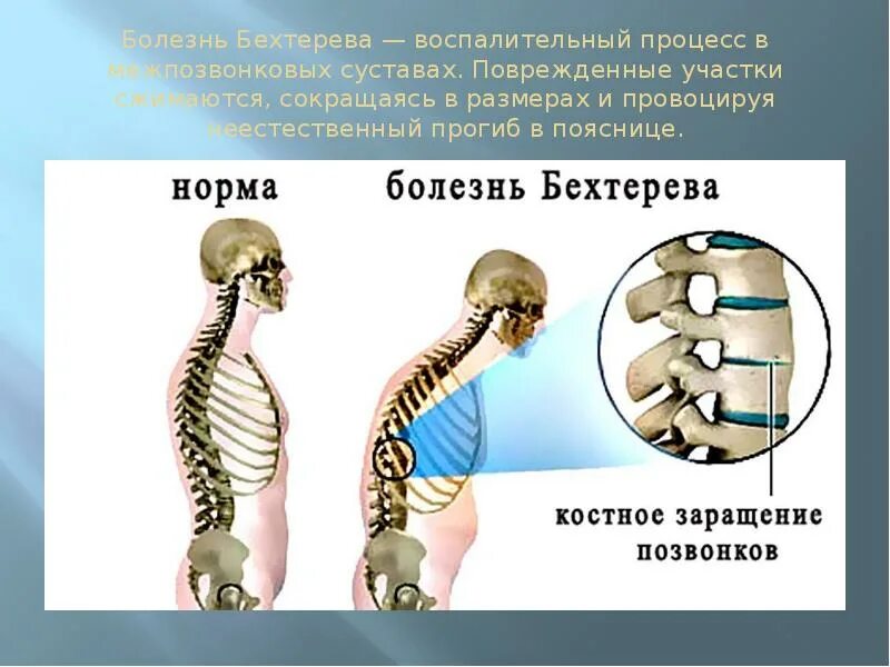 Болезни спины и позвоночника. Анкилозирующий спондилит болезнь Бехтерева. Болезнь Бехтерева скелет. Анкилозирующий спондилез это болезнь Бехтерева. Болезнь Бехтерева (воспаление позвоночника).