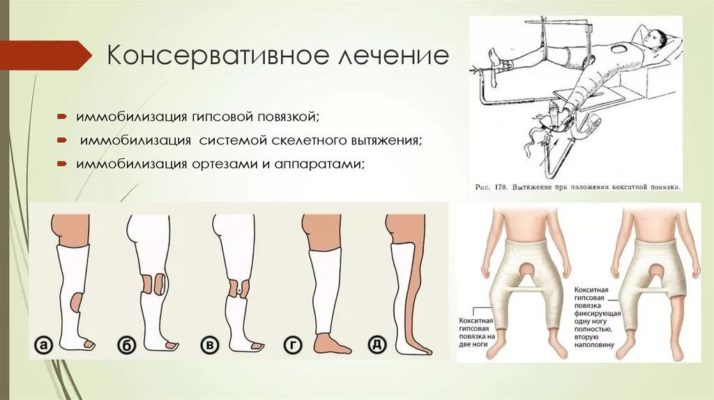 Способы и особенности фиксации конечностей. Гипсовая повязка перелом шейка бедра. Перелом костей таза наложение гипса. Перелом шейки бедра наложение гипса. Перелом бедра гипсовая повязка.