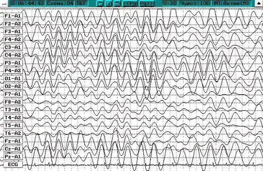 Бета ритм ЭЭГ. Вспышки Дельта волн на ЭЭГ. Дельта-ритм мозга ЭЭГ. Картирование ЭЭГ.