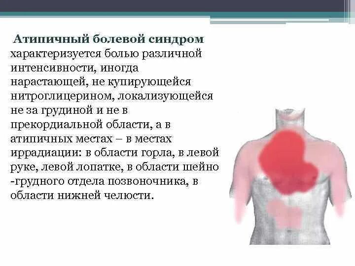 Болевой синдром Окс характеризуется:. Боль за грудиной не купируется нитроглицерином. Атипичный болевой синдром. Иррадиация в левую лопатку