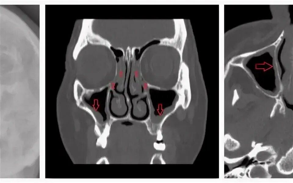 Кт околоносовых пазух гайморит. Гайморит на кт пазух носа. Мрт околоносовых пазух гайморит. Пристеночный отек слизистой
