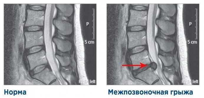 Грыжа поясничного отдела снимки. Протрузия поясничного отдела на рентгене. протрузия дисков позвоночника рентген. грыжа 14 мм поясничного отдела позвоночника. грыжа позвоночника поясничного отдела рентген.