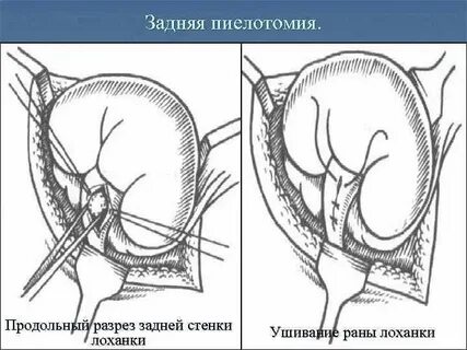 Нефропексия