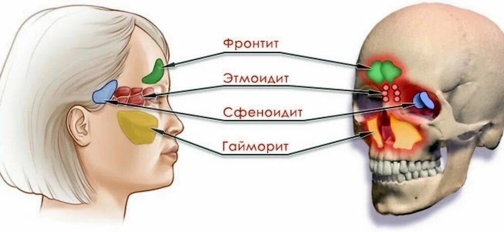 Хронический сфеноидит. Гайморит фронтит синусит этмоидит.