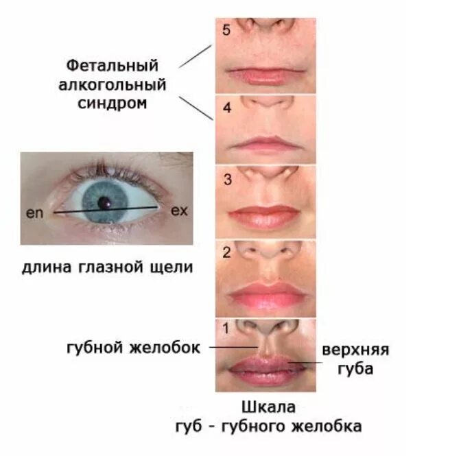 Признаки фетального алкогольного