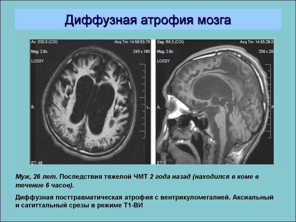 Признаки атрофии мозга