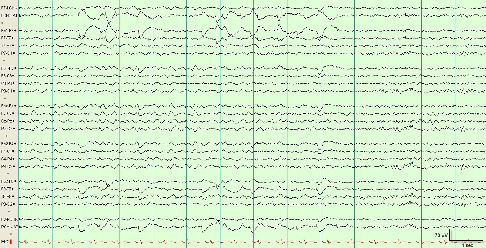 Сколько длится ээг. ЭЭГ p1. Кожно гальванический артефакт ЭЭГ. F7 t3 ЭЭГ. Топокартограммы ЭЭГ.