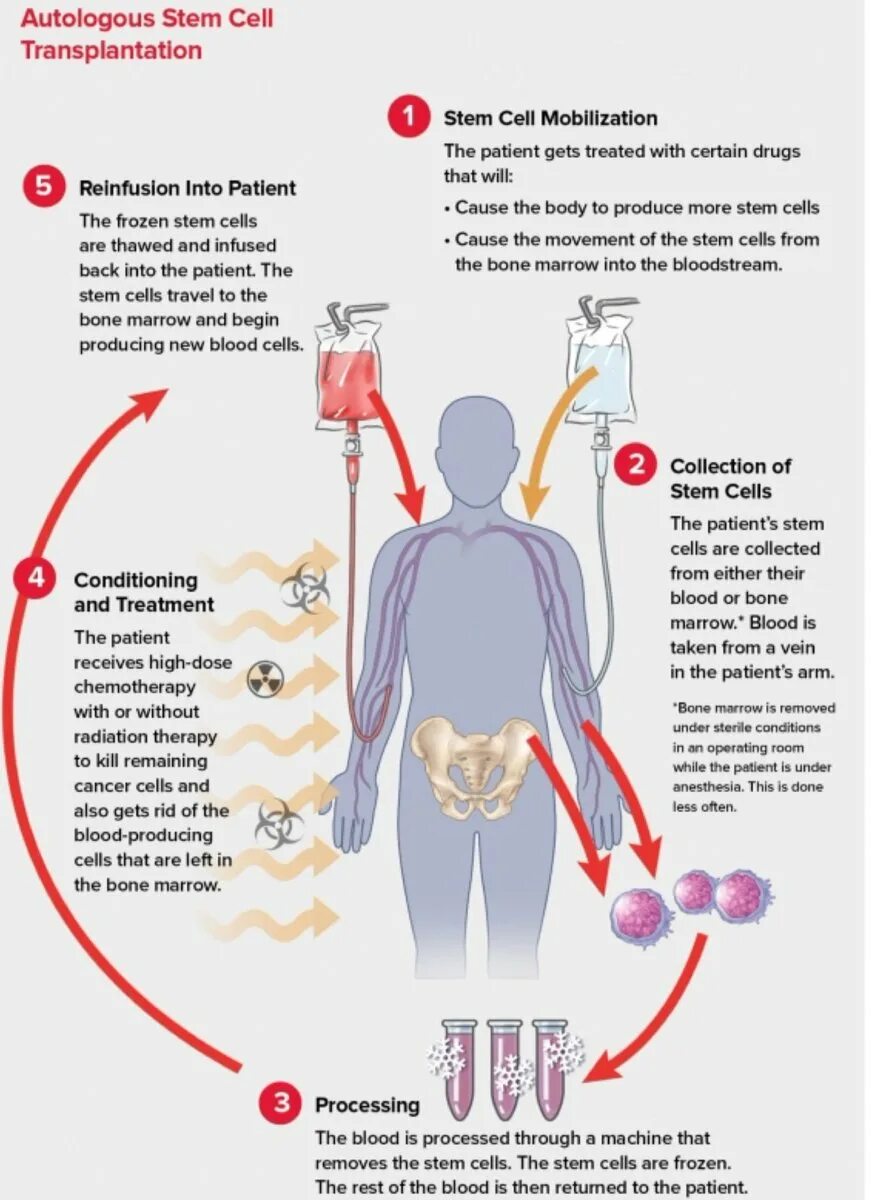 Вред костный мозг. Трансплантация стволовых клеток костного мозга. Трансплантация стволовых клеток схема. Трансплантация гемопоэтических стволовых клеток схема. Трансплантация костного мозга показания этапы проведения.
