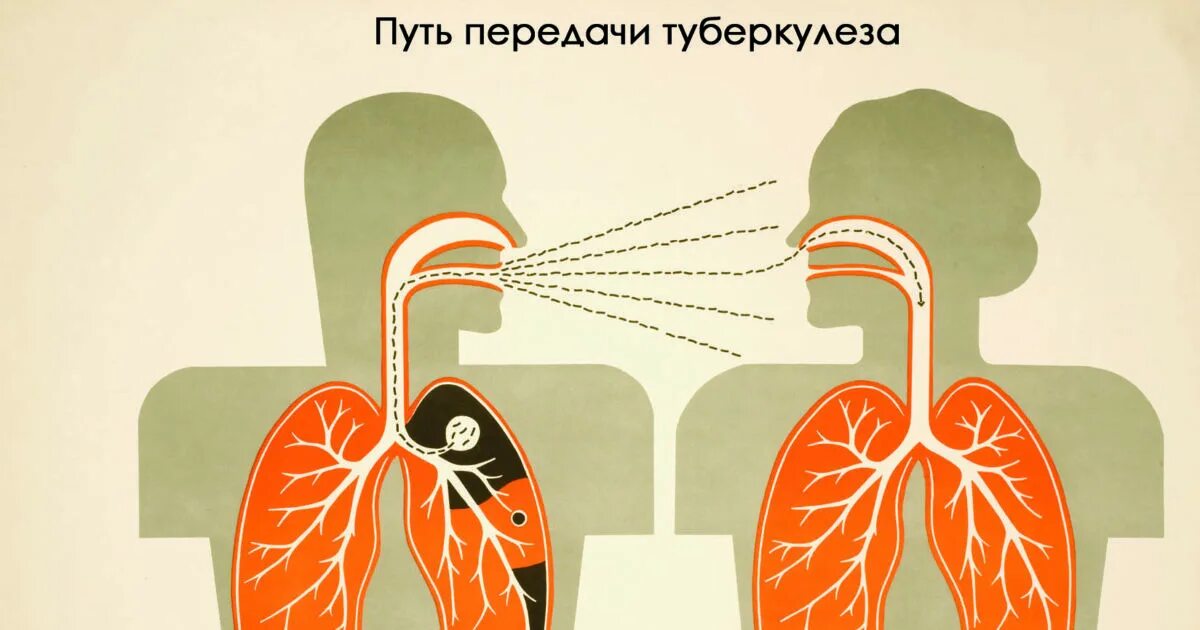 Легко передается воздушно капельным. Пути передачи туберкулеза. Способы передачи туберкулеза. Механизм передачи туберкулеза. Воздушно капельный путь передачи туберкулеза.