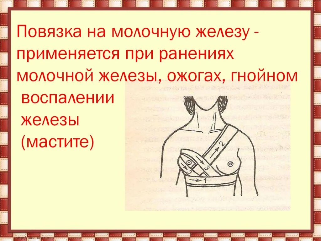 Наложите бинтовую повязку на молочную железу.. Наложение повязки на молочную железу алгоритм. Наложение поддерживающей повязки на молочную железу алгоритм. Наложение повязки на молочную железу на статисте. Перевязать молоко