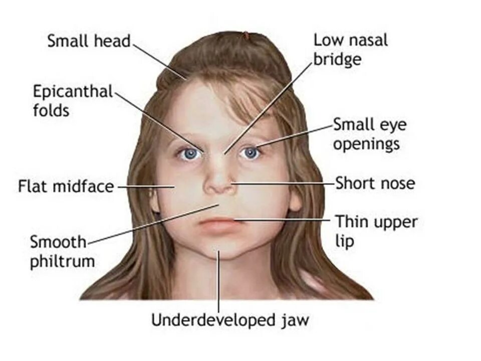 Фетальный алкогольный синдром. ФАС фетальный алкогольный синдром. Фестивальный алкогольный синдром. Фетальный алкогольный синдром лицо. Small head на русском