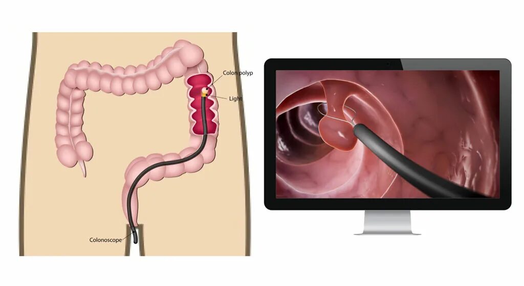 Колоноскопия или фиброколоноскопия. Фиброколоноскопия ФКС что это. Колоноскопия кишечника. Колоноскопия фиброколоноскопия.