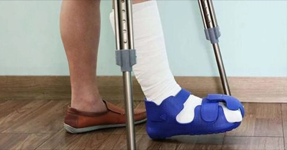 Что одеть на гипс зимой. Отличие перелома от ушиба на стопе. Отличие перелома голени от ушиба. Чем отличить ушиб от перелома ноги