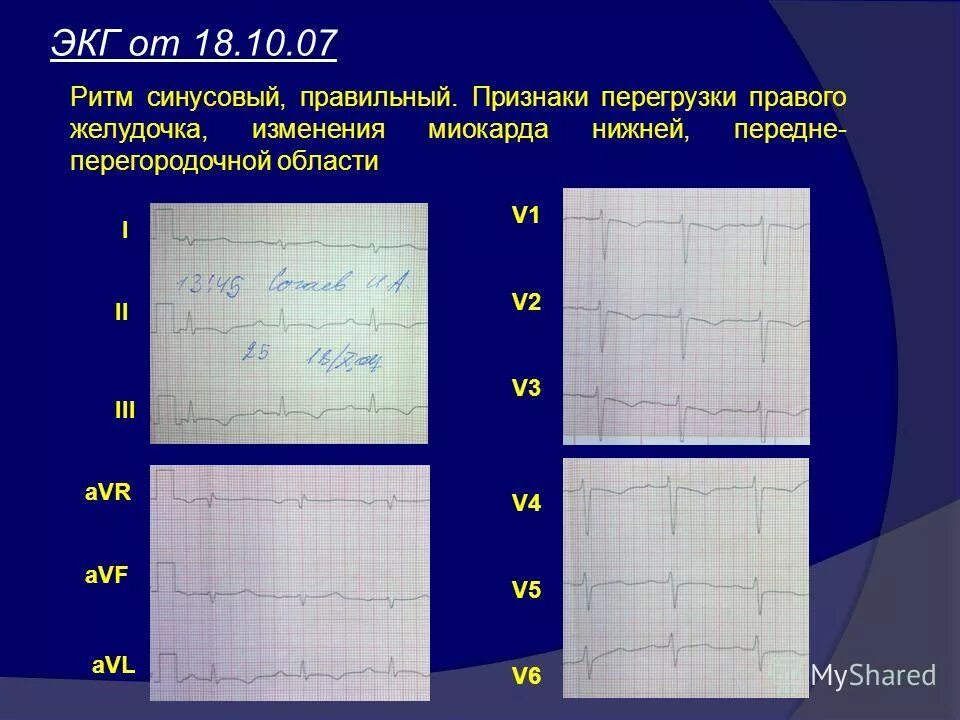 Изменение миокарда перегородочной области. Изменения миокарда передне-перегородочной области. Обменные изменения в миокарде нижней стенки. Возрастные изменения миокарда. Диффузные изменения миокарда по передне-перегородочной области.