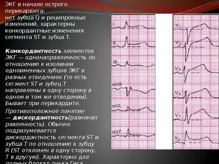 Экг сегмент st на изолинии