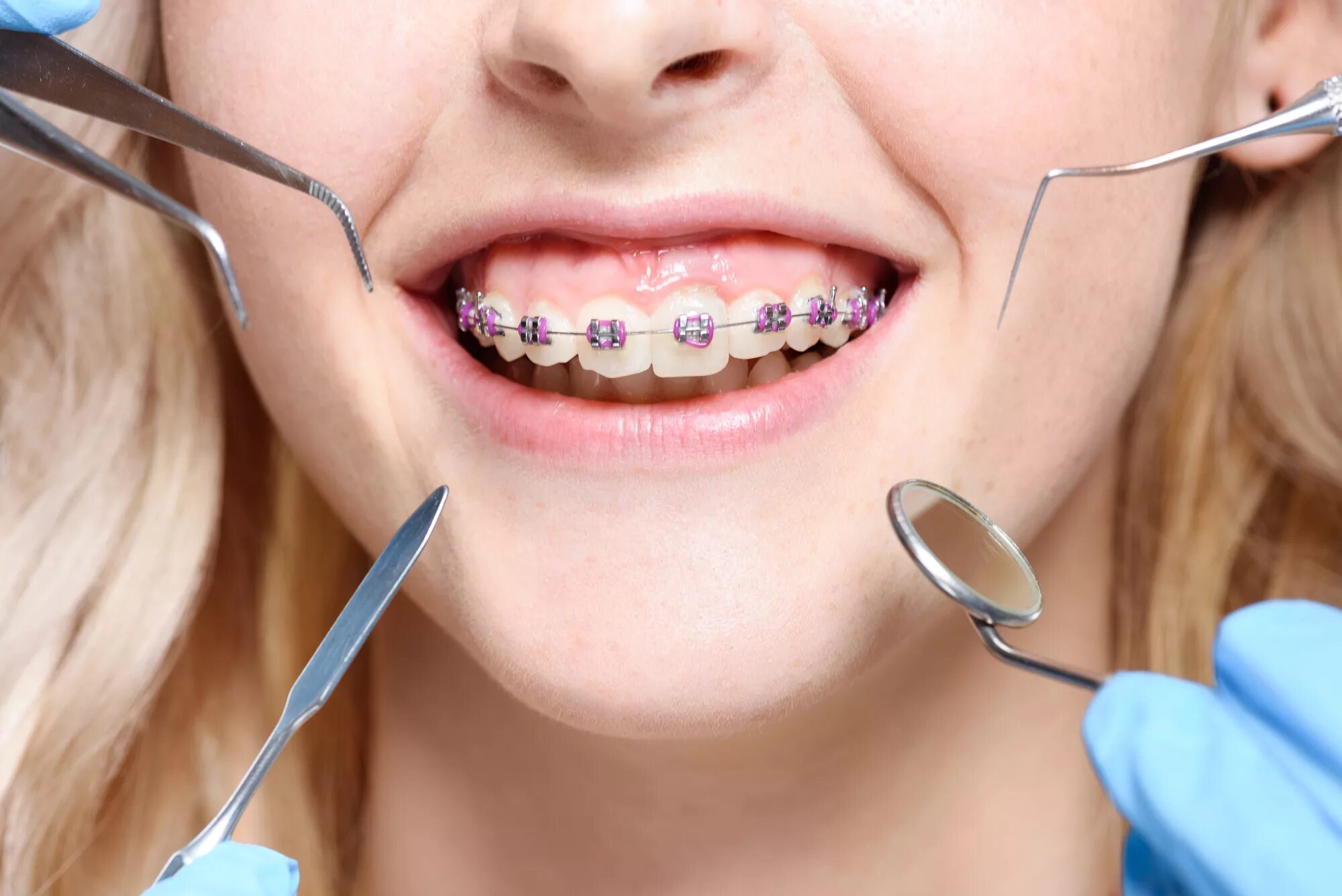 Лигатурные и безлигатурные брекеты. Ортодонтия в стоматологии.