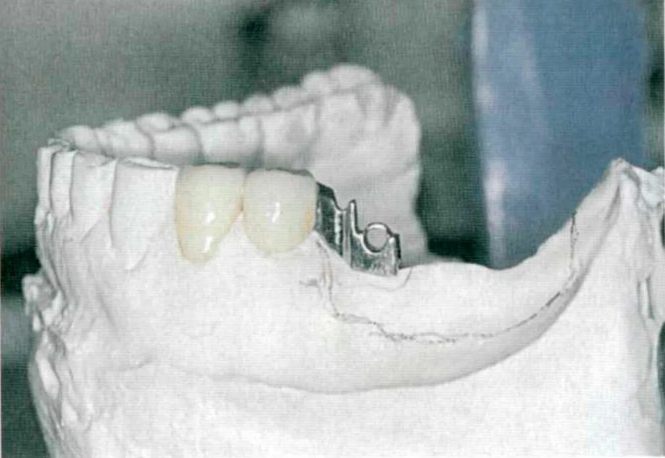 Телескопические и замковые крепления зубных протезов. Комбинированные зубные протезы. Бюгельные протезы клинико-лабораторные этапы изготовления. Комбинированный протез Шура.