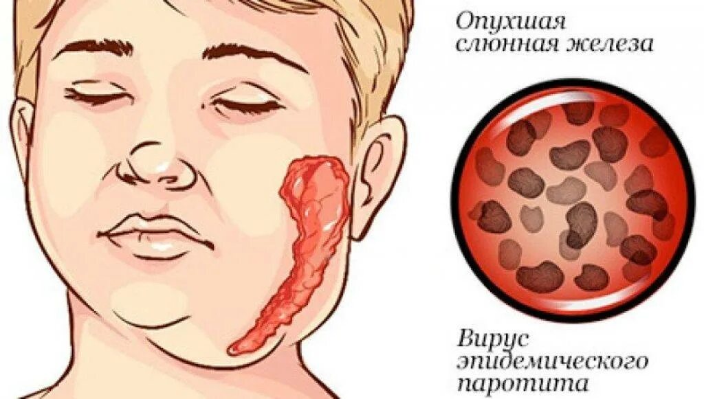 Свинка проходит. Эпидемический паротит возбудитель симптомы. Эпидемический паротит поражение слюнных желез. Паротит Свинка возбудитель.