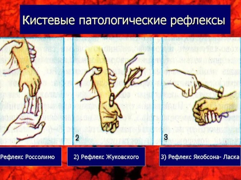 Рефлексы верхних конечностей. Рефлексы Россолимо и Жуковского. Патологические кистевые рефлекс Бехтерева. Патологические кистевые рефлексы неврология. Патологический рефлекс Россолимо.