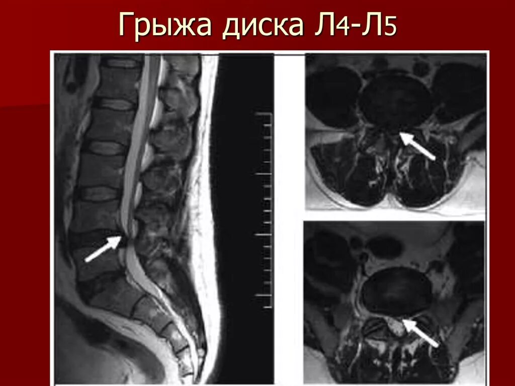 Грыжа 6 мм. Мрт позвоночника пояснично-крестцового отдела (l1-s1). Мрт грыжа диска л4 л5. Протрузии л5 л4 на мрт поясничного.