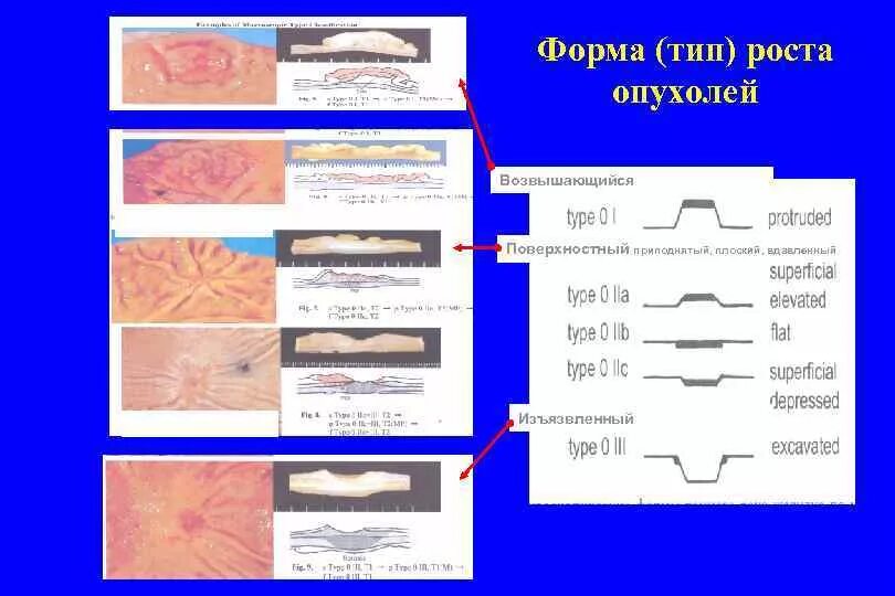 Формы роста опухолей. Схемы различных форм опухолей. типы роста опухолей. вид опухолей при различных формах роста.