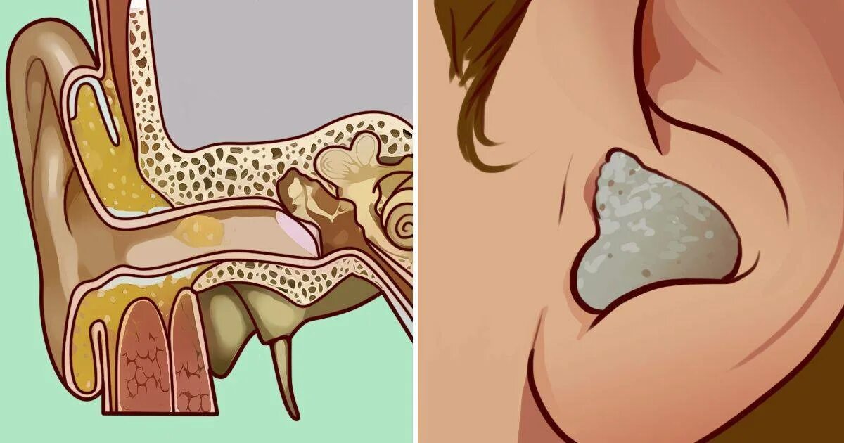 Почему одно ухо плохо. Ушная серная пробка симптомы. Отомикоз серная пробка.