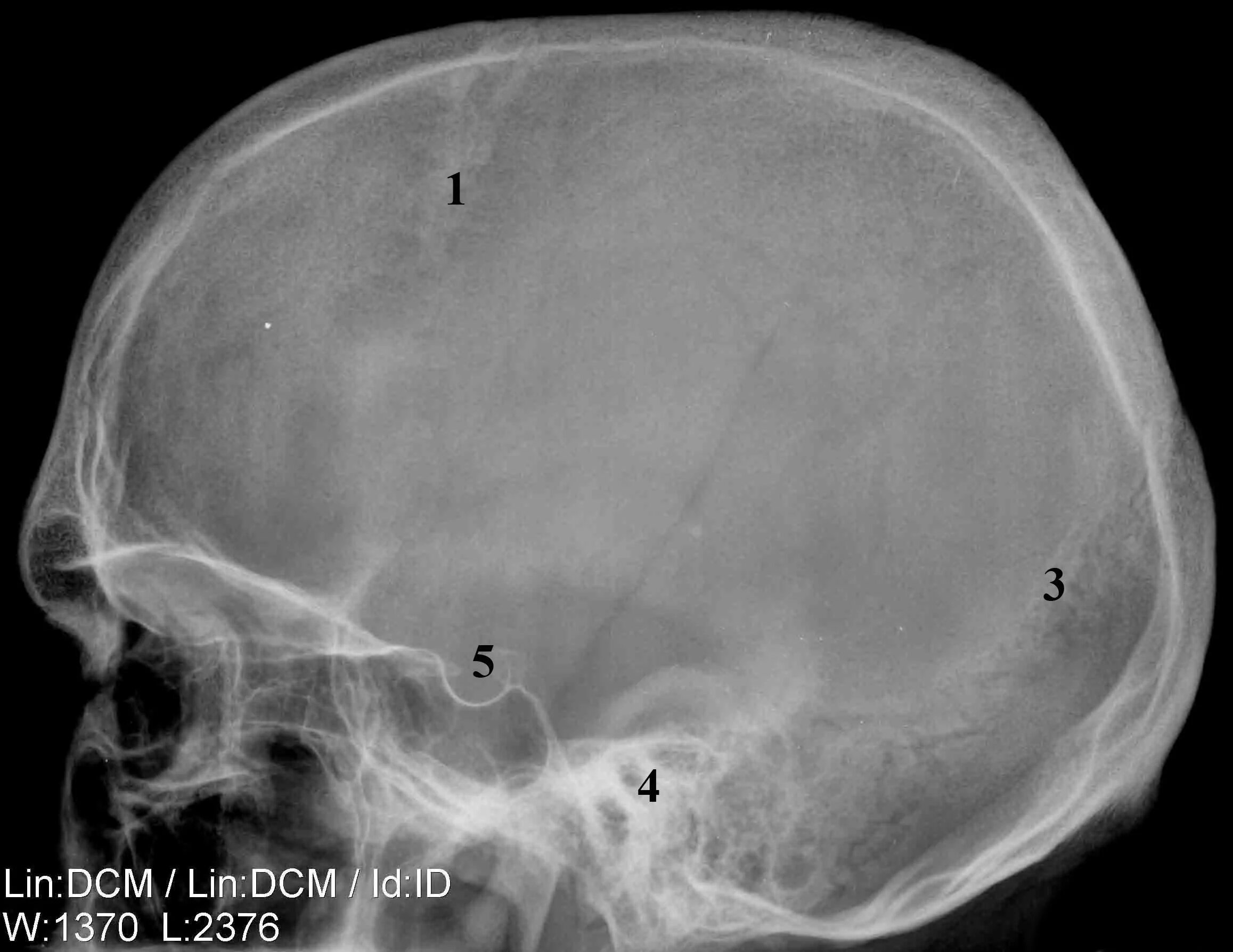 Кости черепа рентген. Рентген черепа в боковой проекции норма. Рентген костей свода черепа. Височная кость черепа рентген. Рентген снимки перелома лобной кости черепа.