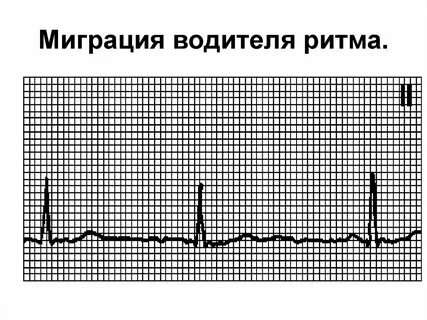 Миграция водителя ритма на экг что это