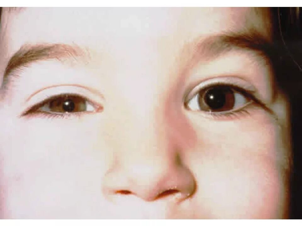 Врожденный птоз. Бернара-горнера (птоз, миоз, энофтальм).. Синдром горнера врожденный. Антимонголоидный разрез глазных.