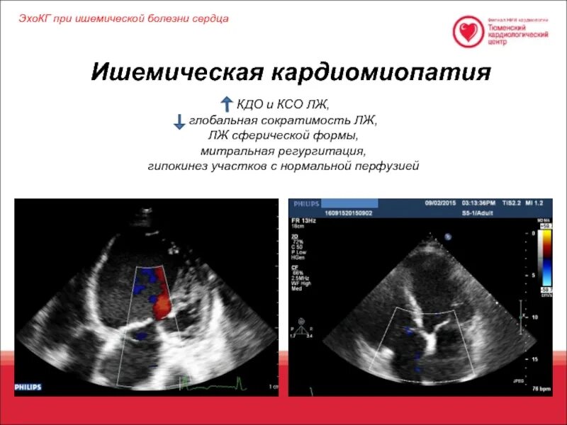 Гипокинез базального сегмента