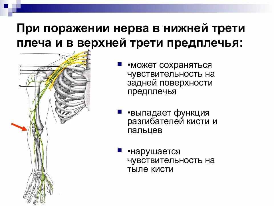 Поражение лучевого нерва в верхней трети плеча. Нерв предплечья. Защемление лучевого нерва. Лучевой нерв на плече.