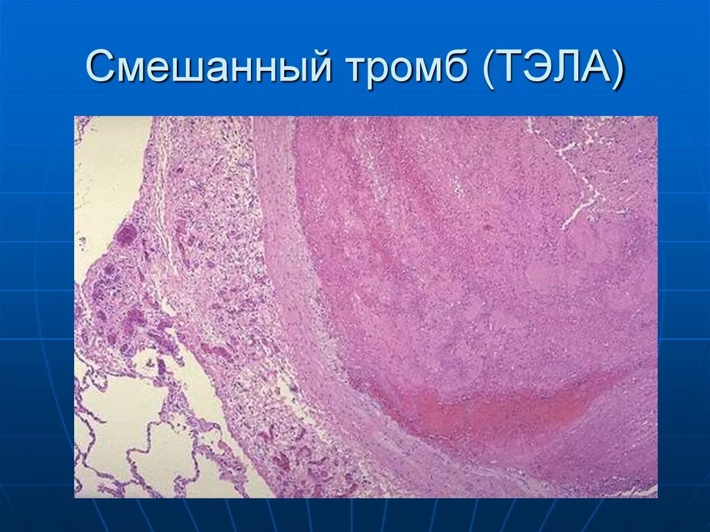 Смешанный тромб артерии микропрепарат. Смешанный тромб микропрепарат. Смешанный тромб в Вене микропрепарат. Смешанный тромб макропрепарат. Тромб микропрепарат