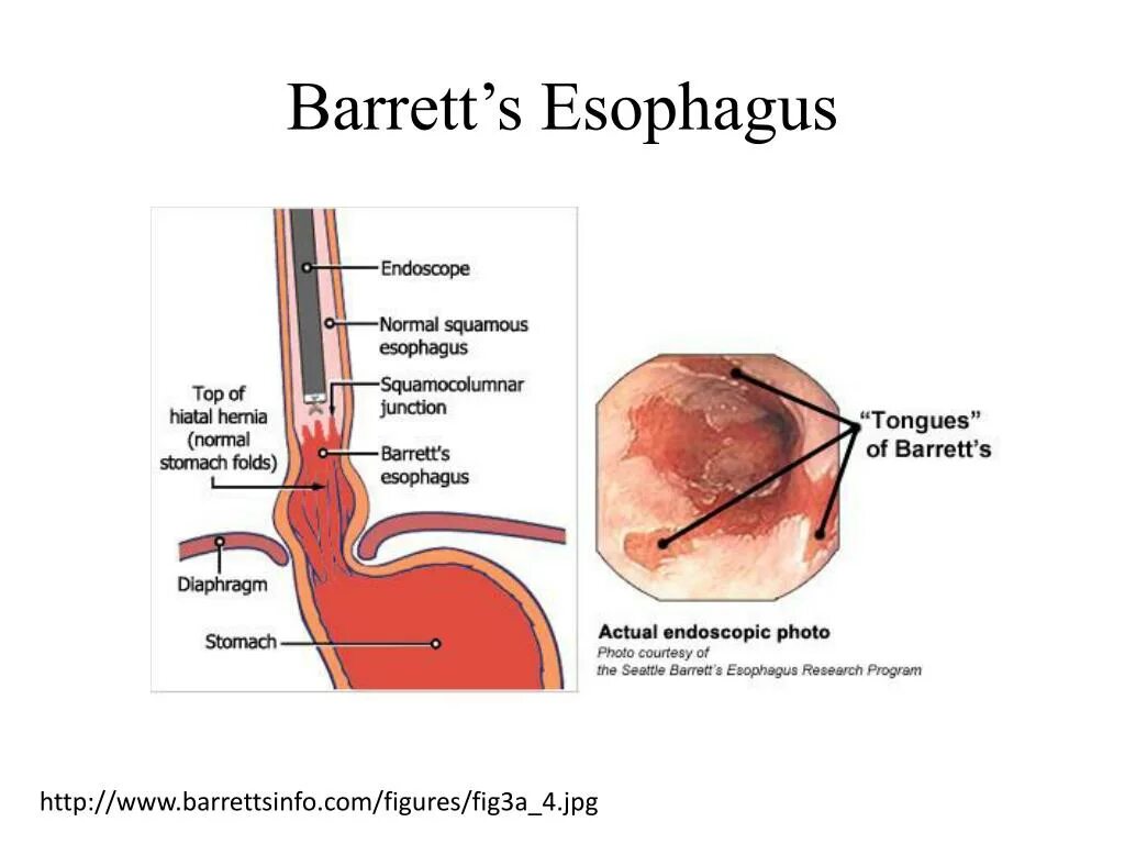 Пищевод баретта. Барретто пищевод Барретта. Пищевод Барретта (с 1 m2).. Пищевод Барретта протокол.
