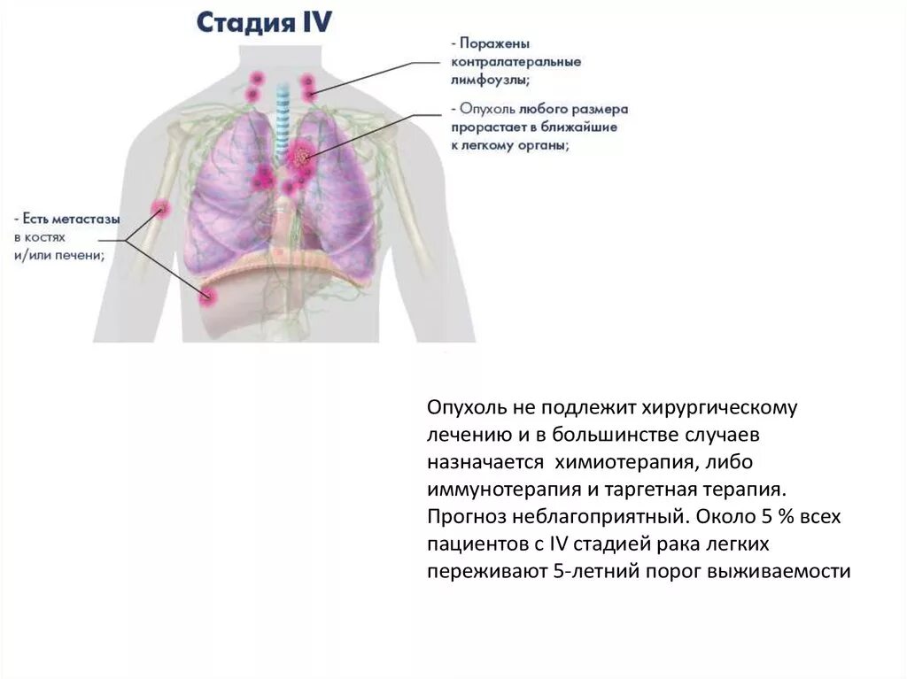 Легочные лимфоузлы. Лимфатические узлы легких. Воспаление лимфатических узлов легких. Аксиллярные лимфатические узлы в легких.