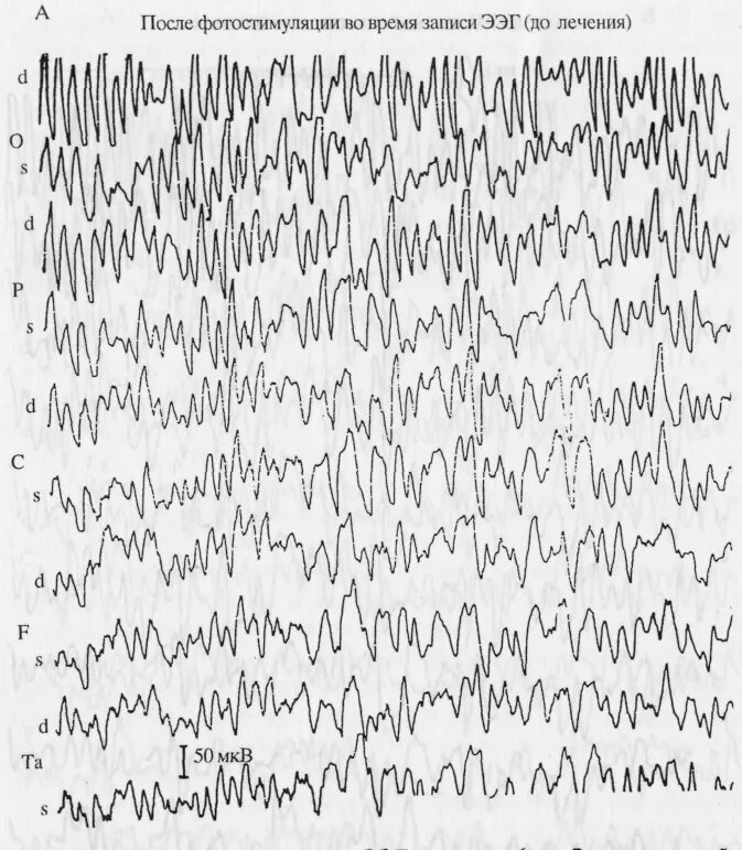 Срок ээг. ЭЭГ ночной сон видеомониторинг. Видеомониторинг ЭЭГ при эпилепсии. Усвоение ритма фотостимуляции на ЭЭГ. Тип реакции на ЭЭГ при фотостимуляции.