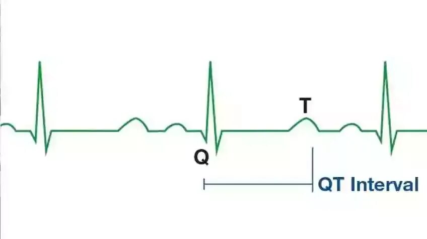 Синдромы короткого интервала qt (SQTS). Синдром qt на ЭКГ. Qt на ЭКГ. Удлиненный интервал qt. Удлиненное qt у ребенка