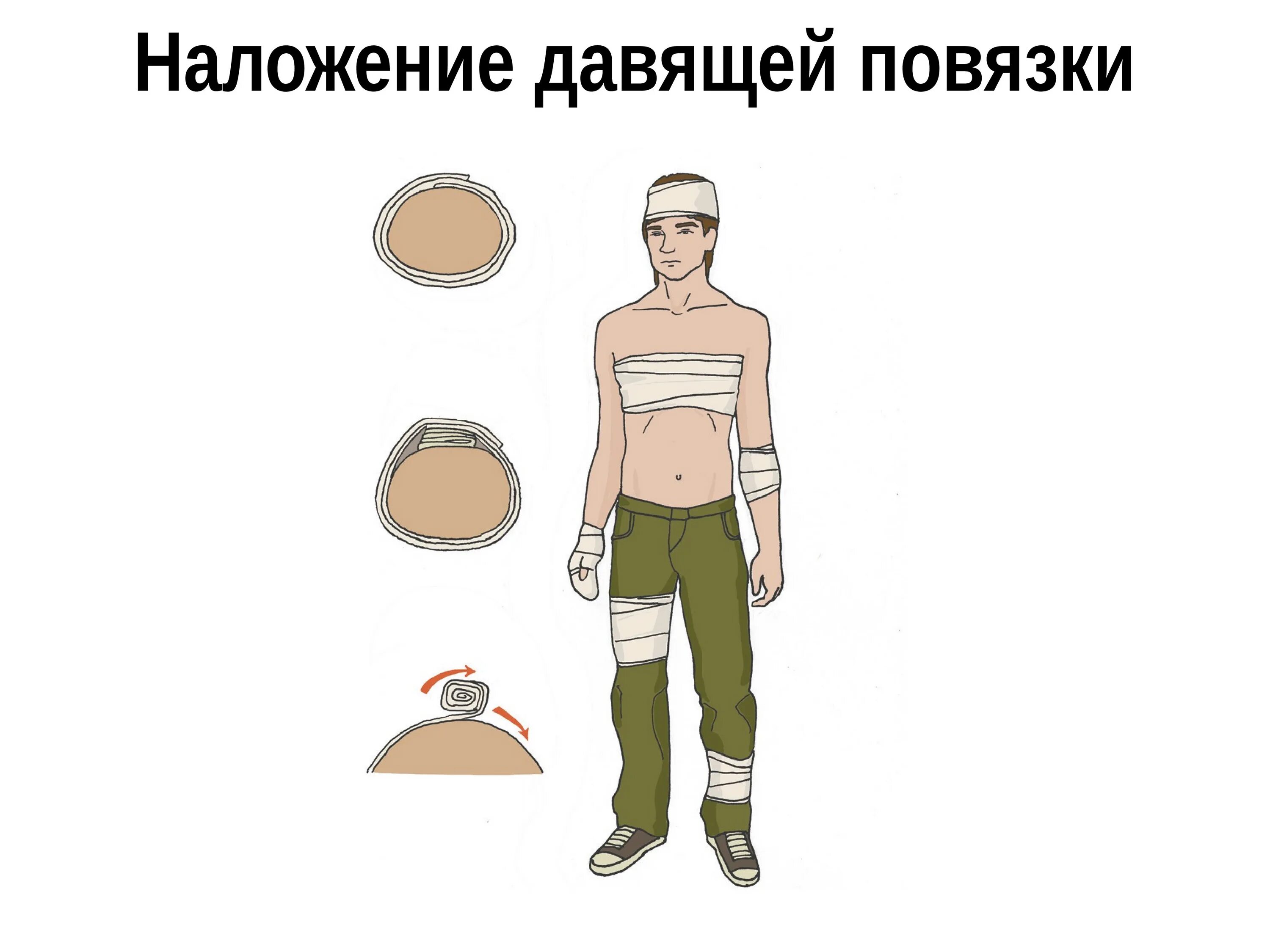 Техника наложения давящей повязки при кровотечении. Наложение давящей повязки при кровотечении.