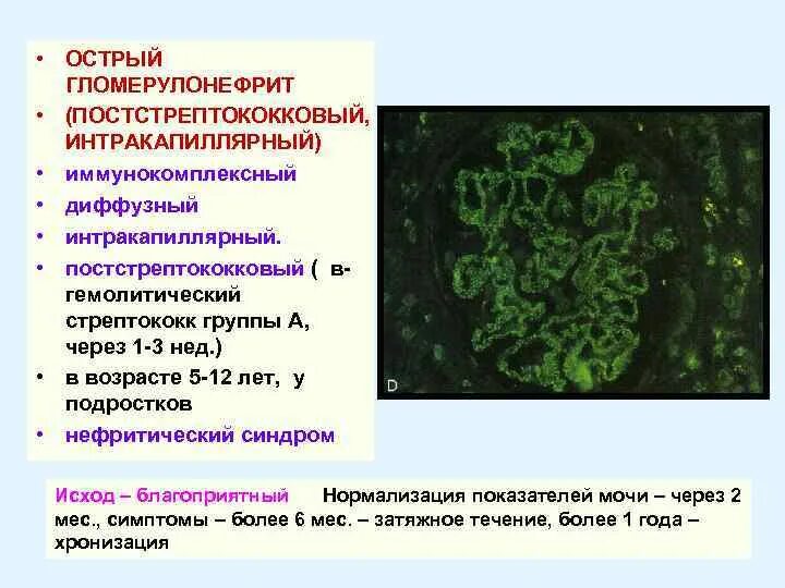 Гемолитический латынь. Бета гемолитический стрептококк группы а гломерулонефрит. Постстрептококковый гломерулонефрит клиника. Острый постстрептококковый гломерулонефрит патогенез. Бета гемолитический стрептококк и почек.