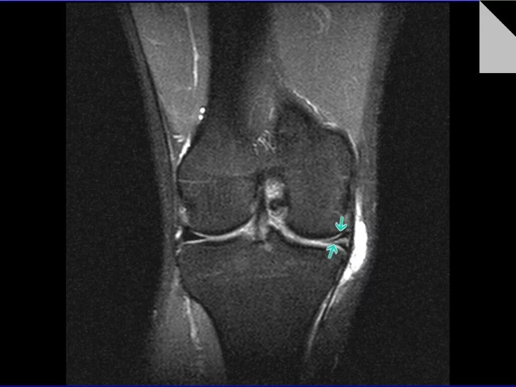Мрт коленного сустава разрыв мениска. Параменисковая киста коленного сустава мрт. Повреждение мениска коленного сустава мрт. Разрыв мениска коленного сустава рентген.