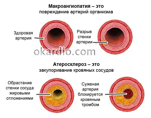 Макроангиопатия что это такое. Диабетическая макроангиопатия атеросклероз. Микроангиопатия и макроангиопатия. Макроангиопатия периферических артерий. Макроангиопатия сосудов шеи что это такое.