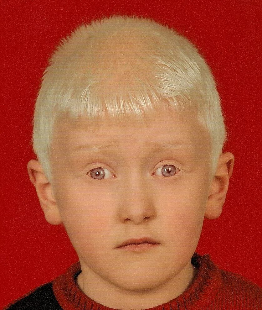 Страдающий альбинизмом. Синдром Чедиака-Хигаси. Синдром Чедиака-Хигаси синдромы. Синдром Чедиака-Хигаси альбинизм.