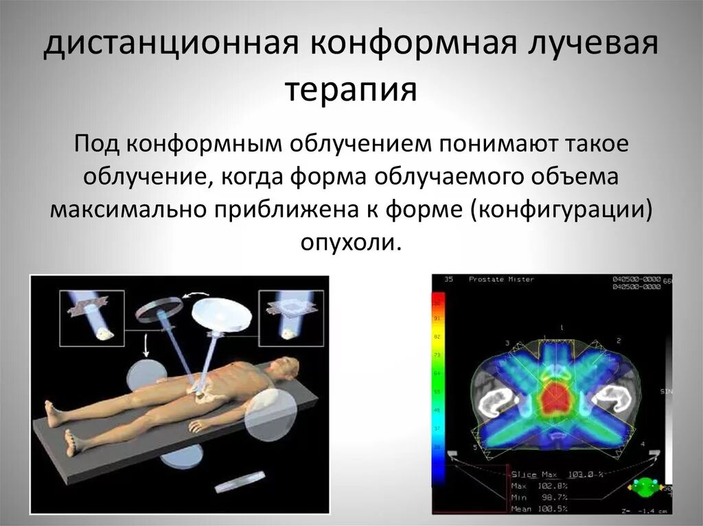 Конформная лучевая. IMRT лучевая терапия. Конформальная лучевая терапия (3d-CRT). Дистанционная стереотаксическая лучевая терапия. Трехмерная конформная лучевая терапия.