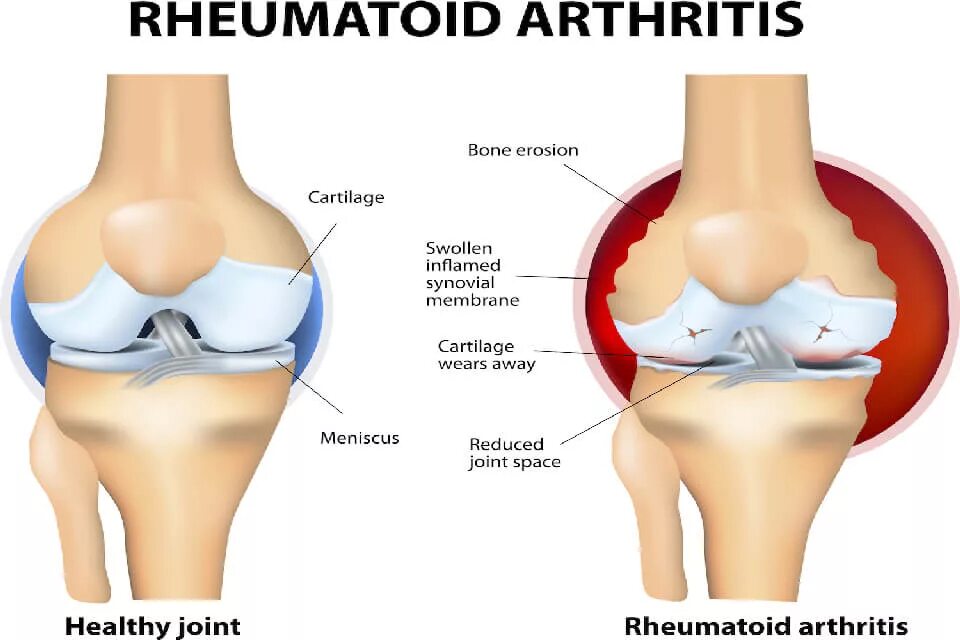 Скрип в коленях. Ревматоидный артрит коленного сустава. Ревматоидный артрит тазобедренного сустава.