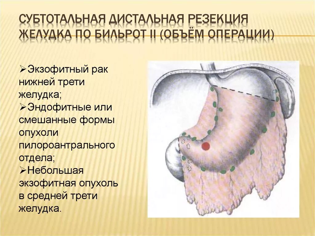 Проксимальная субтотальная резекция желудка показания. Субтотальная резекция желудка операции. Дистальная резекция желудка. Дистальная субтотальная резекция желудка.