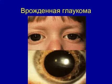 Поставь глаукома
